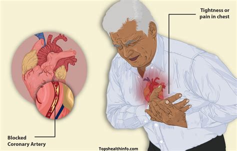 angina pectoris